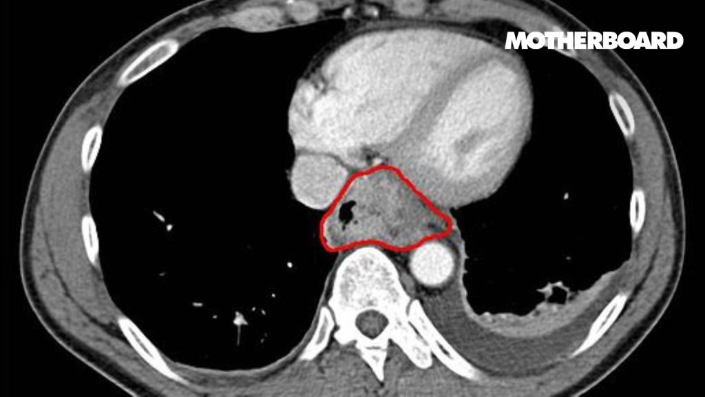 This Computer Program Detects Cancer Earlier Than Ever – Without Surgery