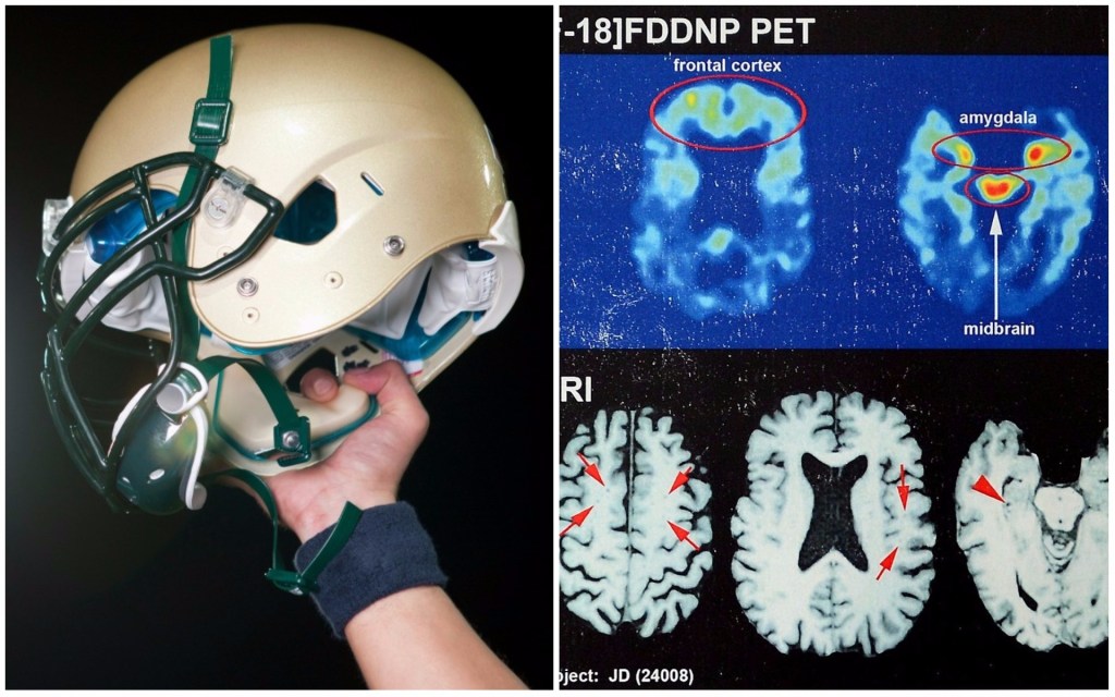 Degenerative Disease Found in 99 Percent of NFL Players’ Donated Brains