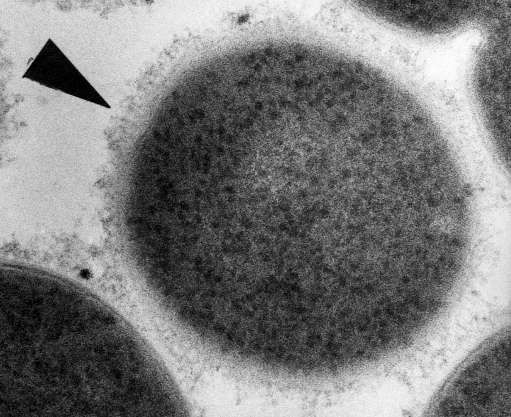 〈人食いバクテリア〉とは何か。発見した臨床医が語る、その実態