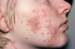 cystic acne