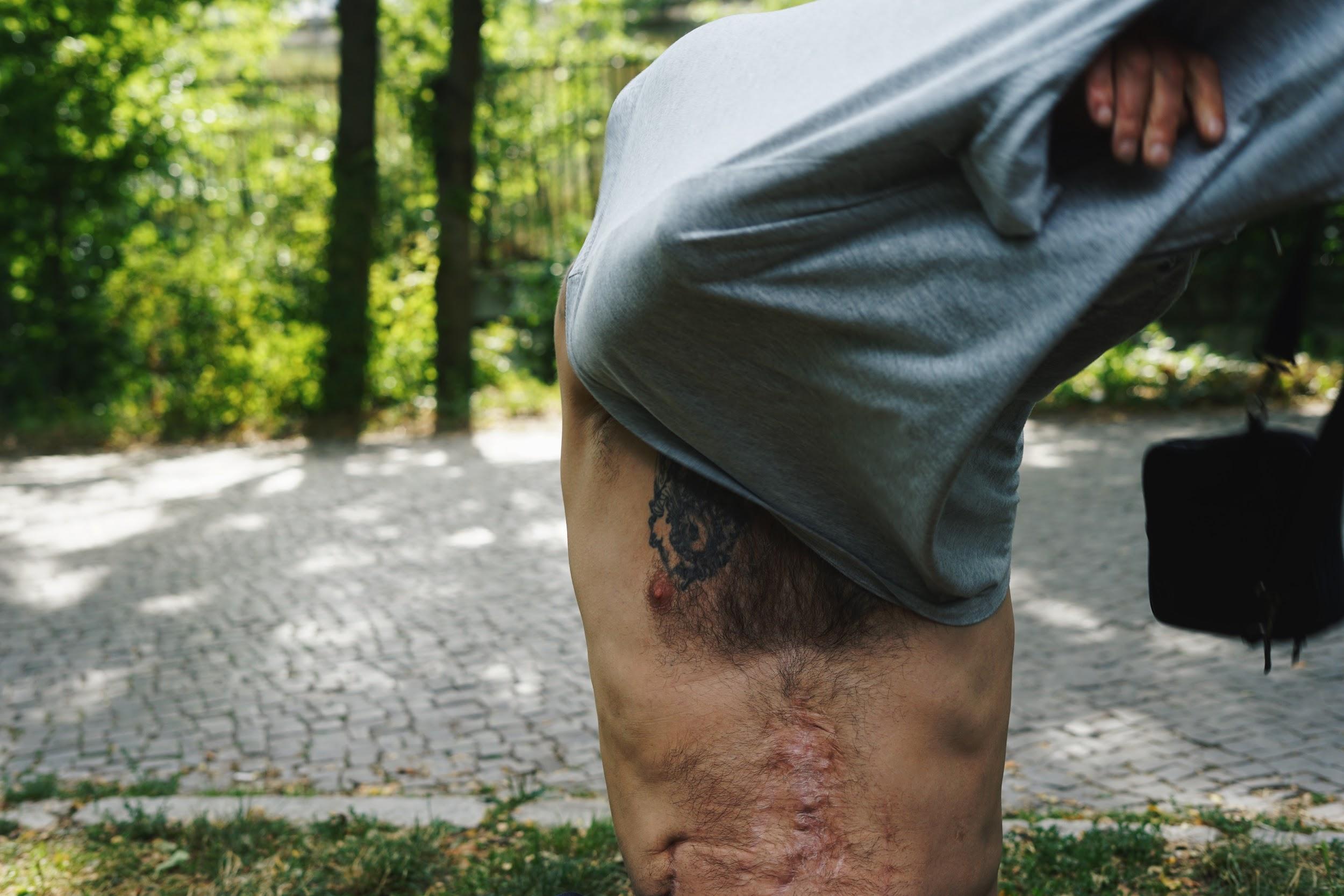 Ein Mann sieht sich sein T-Shirt über den Kopf, auf seiner rechten Brust trägt er ein Tattoo, darunter spannt sich eine breite Narbe