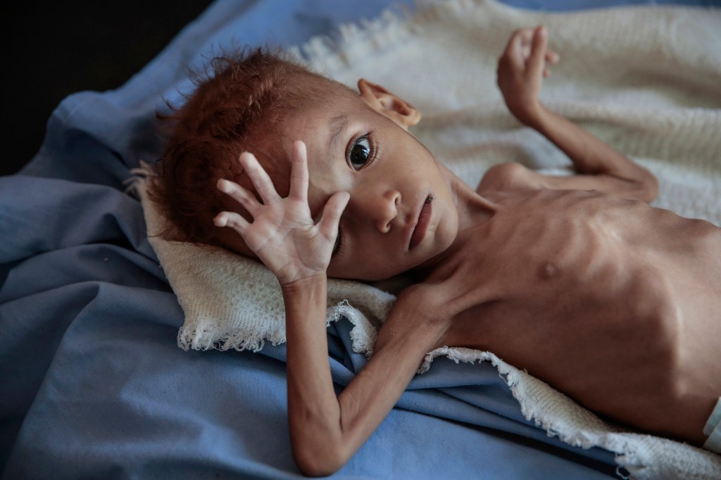 One doctor’s desperate attempt to save Yemen's starving children