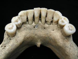 ​The lower jaw of a Medieval woman with ultramarine particles in her calculus. Image: Christina Warinner