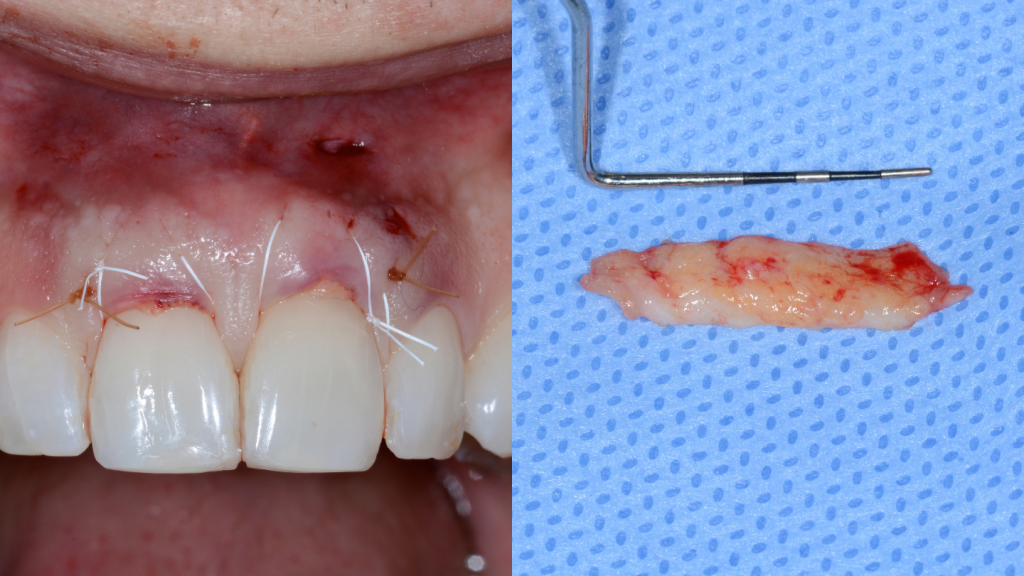 Split image of a person's gums and a slice of flesh