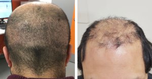 hair-transplant-surgery-gone-wrong