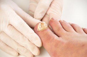 GettyImages-603836810-doctor-checking-big-toe-fungus