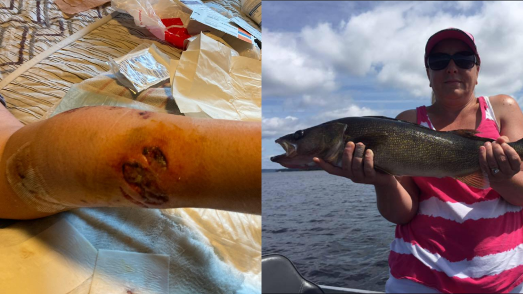 Kim Driver's leg after being attacked by a muskie, left; Driver proudly holds up a walleye in her Facebook profile photo, right.