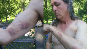 Randall May with bruises and scratches after the arrest