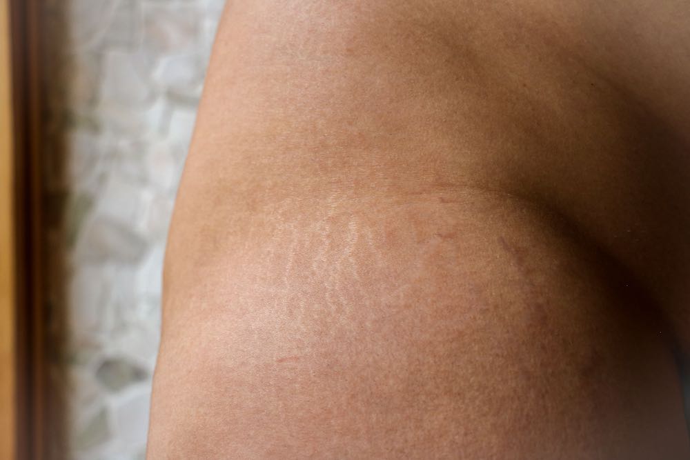 STRETCH MARKS 3.jpeg