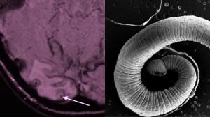 brain scan tapeworm