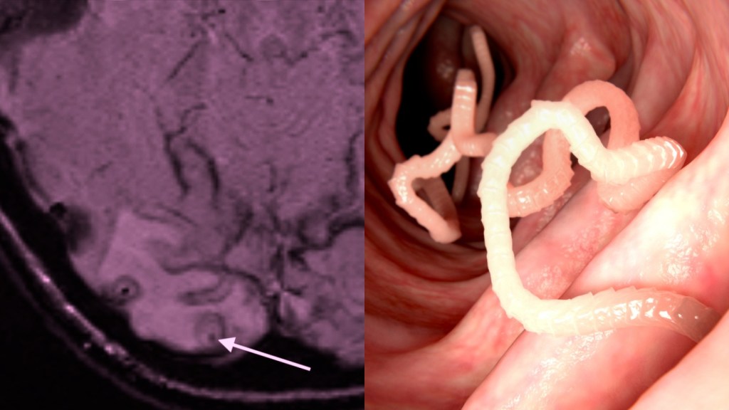 tapeworm brain