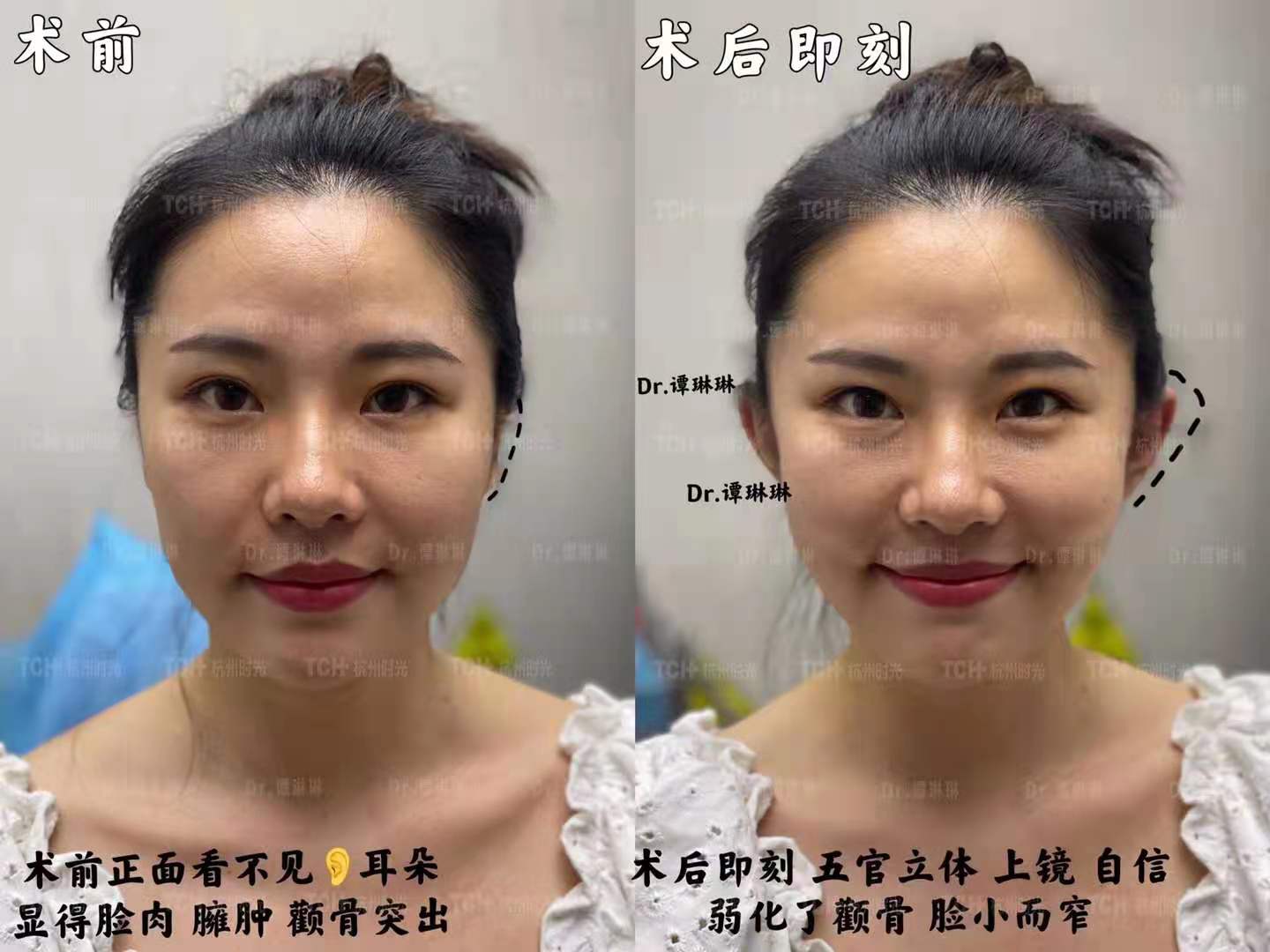 Perempuan sebelum dan sesudah operasi “telinga elf”. Foto: Time Plastic & Cosmetology Hospital