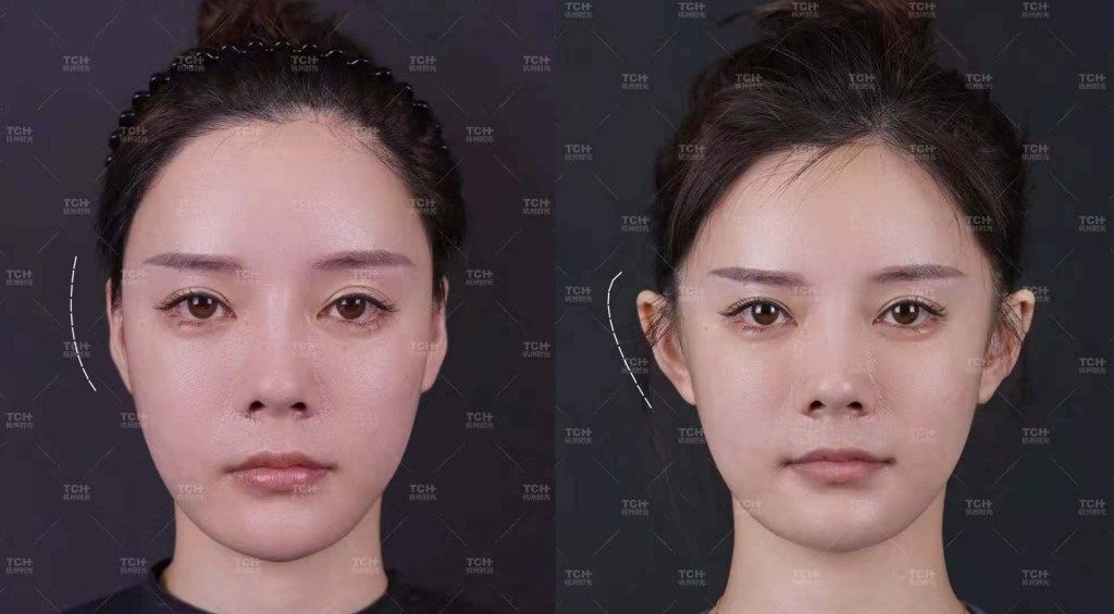 Why People in China Are Undergoing Cosmetic Procedures To Get ‘Elf Ears’