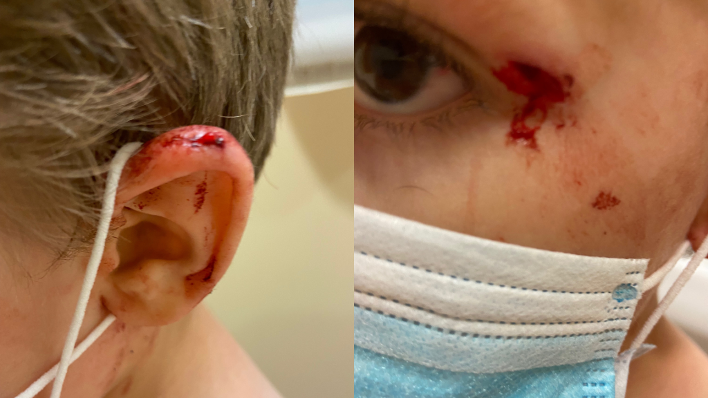 Josh Forbes' 5-year-old son with a bloody ear and eye-area after being attacked by a K9 police dog in Pasadena, California. (Photo courtesy of Josh Forbes)