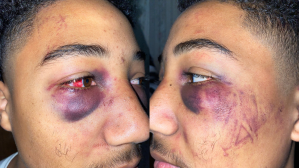 ​Bruises on Devin Carter's face after two former officers from the Stockton Police Department allegedly assaulted him.