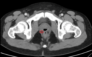 A CT scan of the man's pelvis, with an arrow showing where the fistula is.