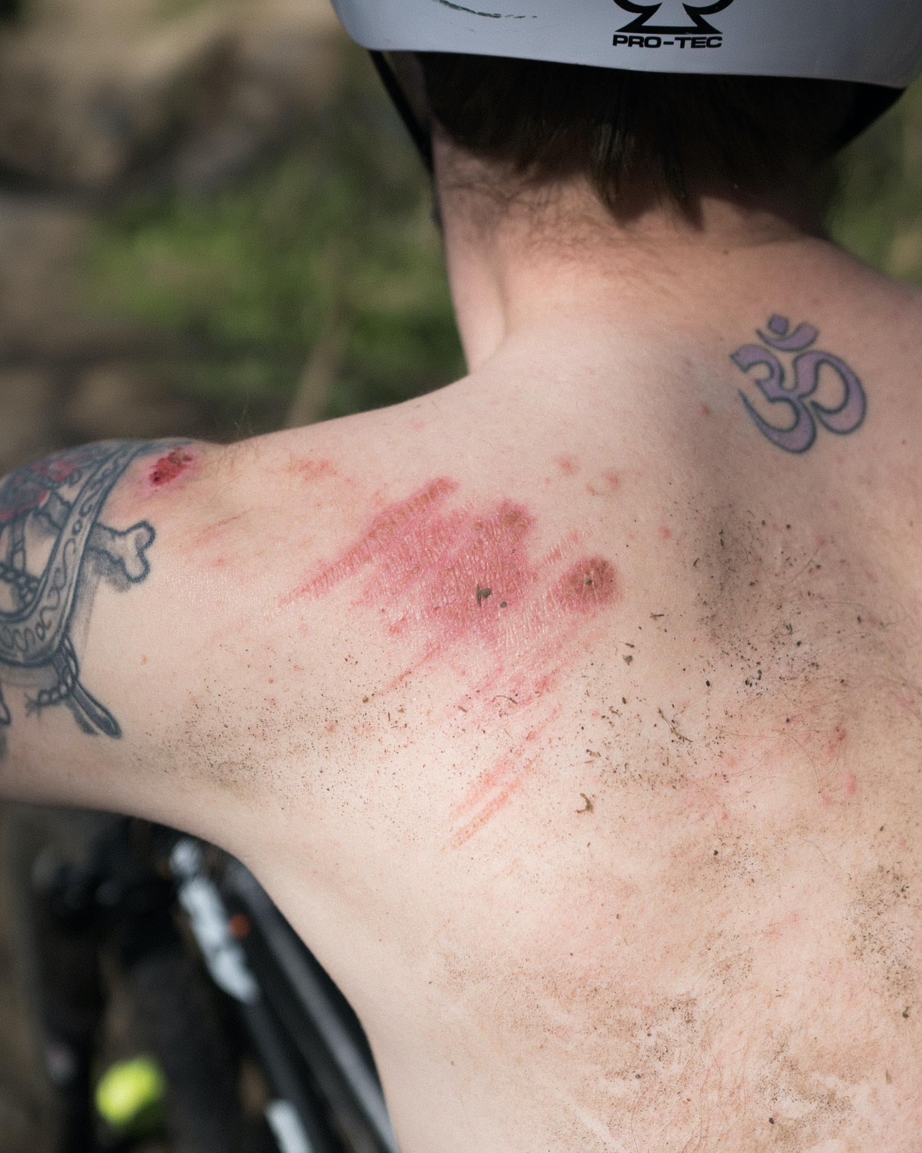 Cuts and bruises on a rider's shoulder.