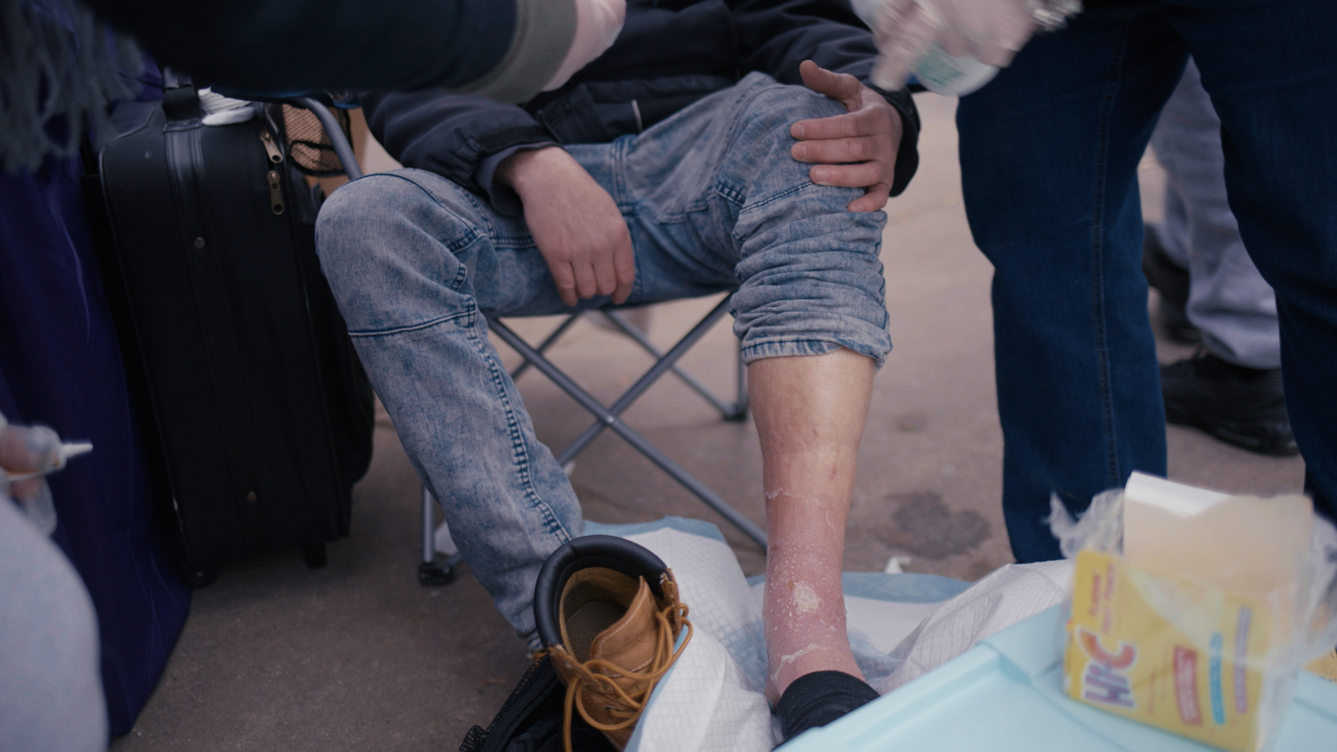 A man with a blistering ankle gets wound care.