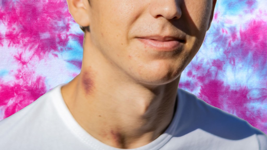 hickey