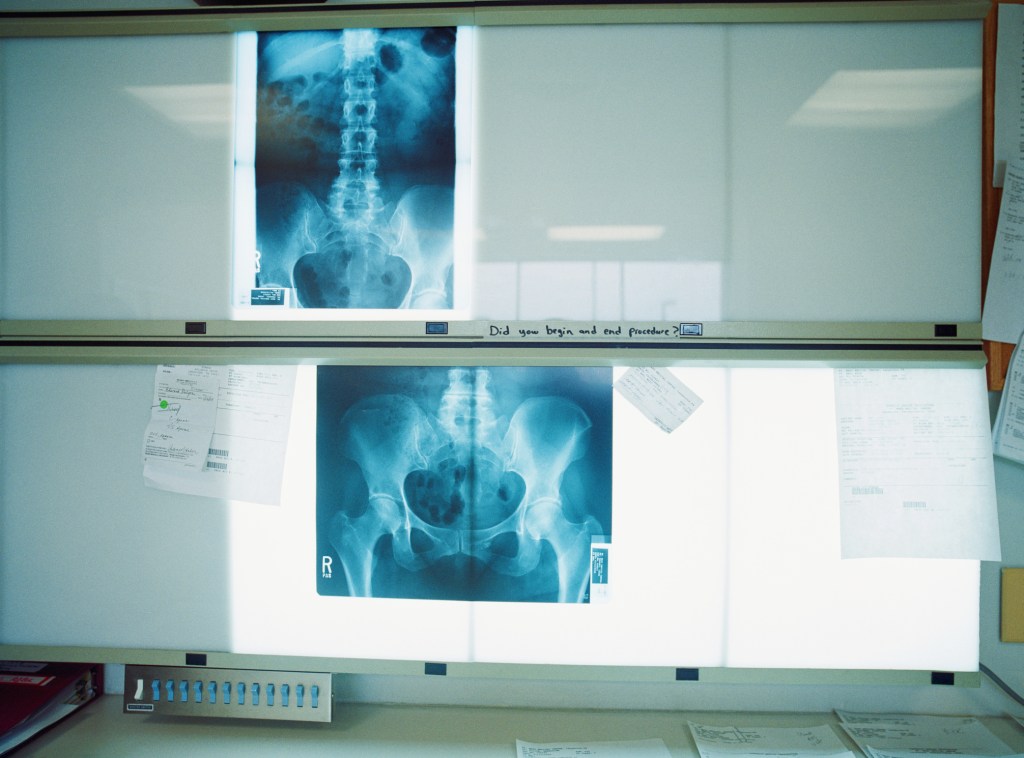 X-rays hanging up in a medical office. Getty Images.