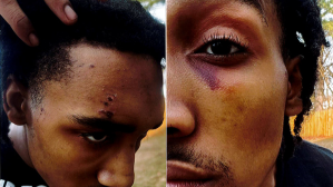 ​Photos of Monterrious Harris taken nine days after he says he was attacked by police.