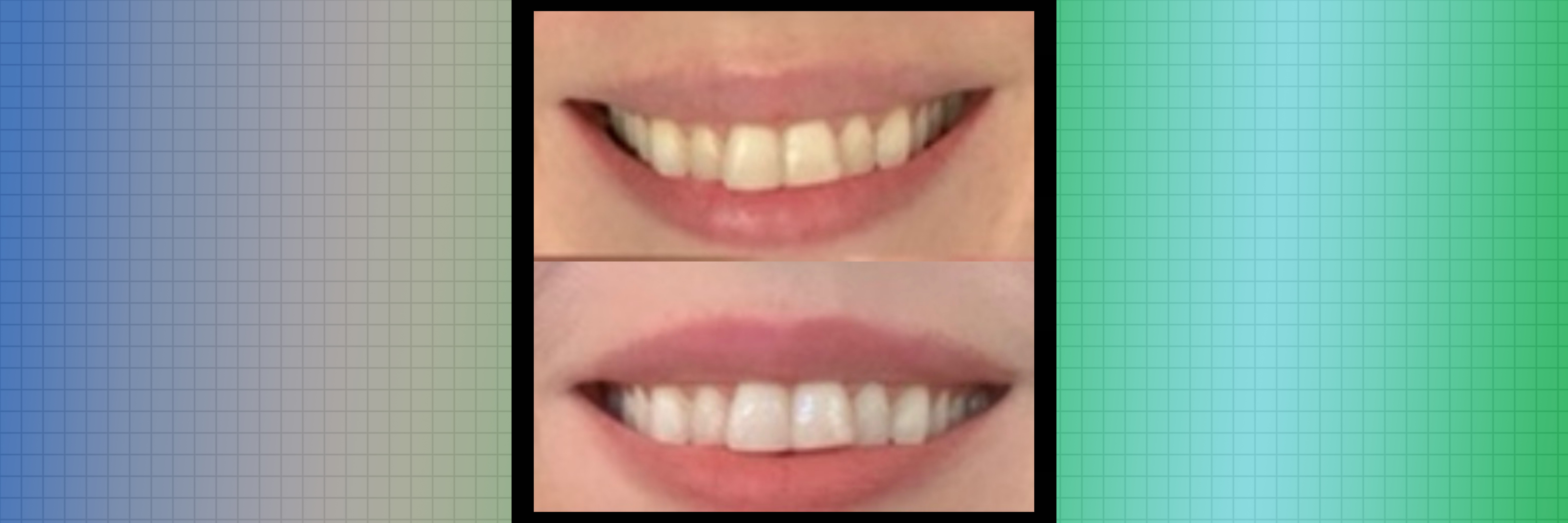 crest-whitestrips-before-after.jpg