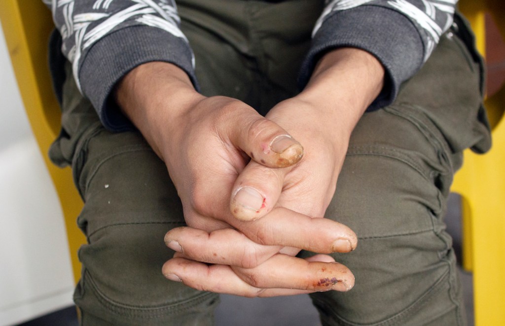 Transit, Brussels – closeup of a person holding their hands clasped together on top on their knees as they are sitting. They hands have many scabs and injuries.