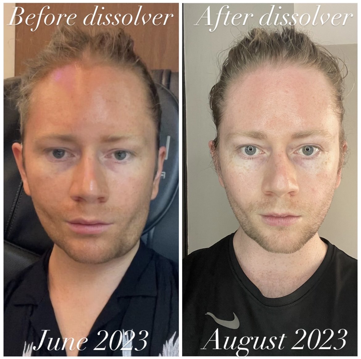 A man with botched fillers before and after filler dissolver